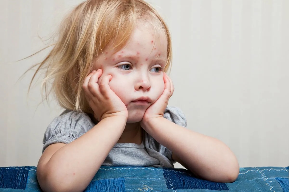 How Do You Test For Chickenpox?